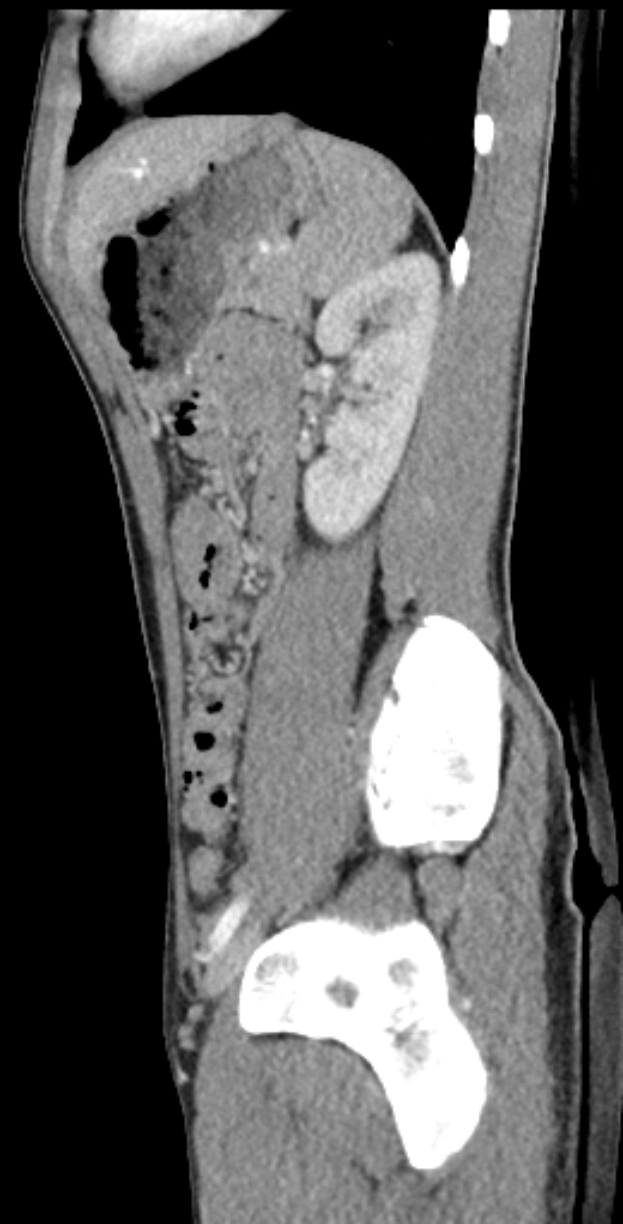Eine MRT-Aufnahme eines Knies, die einen Bruch in der Mitte zeigt, mit einem dunklen Hintergrund drumherum.