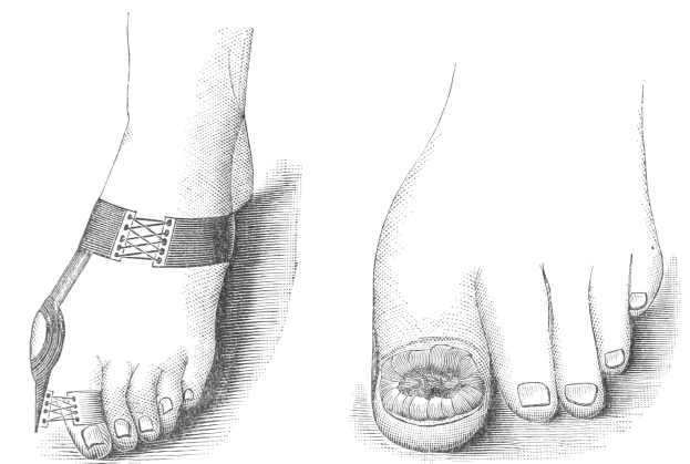 Schwarze und weiße Zeichnung eines Paares Füße, einer mit einem Verband und der andere mit einem Bruch, mit Text, der die Behandlung angibt.