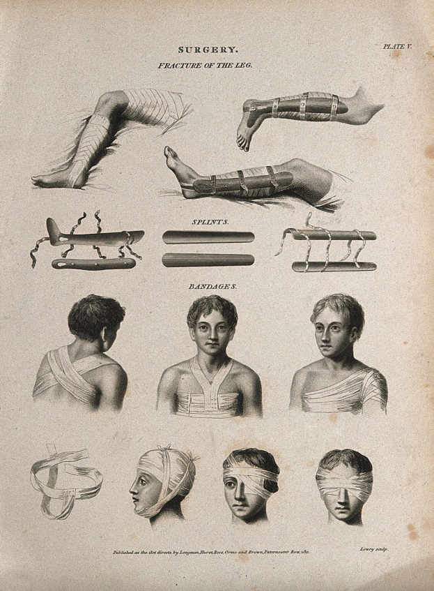 Ein medizinisches Illustration aus dem 19. Jahrhundert, das die Beine eines Mannes und den Kopf einer Frau zeigt, beide mit Verband um den Kopf, begleitet von beschreibendem Text.